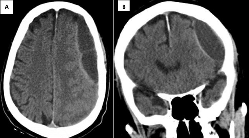 Figure 2 Brain computed tomography (CT) showing subdural hematoma of 2.6 cm in both axial (A) and coronal (B) views.