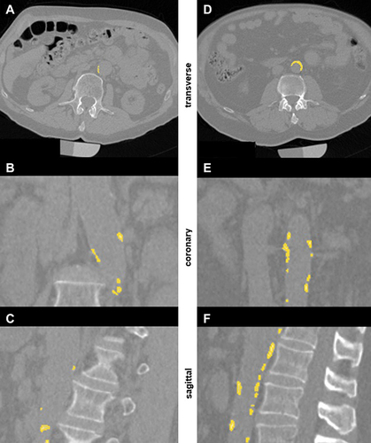 Figure 3 Segmentation of baseline AAC volume in CT images. (A-C) Participant with low BL AAC of 1468 mm³ and an increase of ∆ 11.97%; (D-F) Participant with high BL AAC of 5208 mm³ and an increase of ∆ 8.8%. (A and D) transverse section; (B and E) coronary section; (C and F) sagittal section.