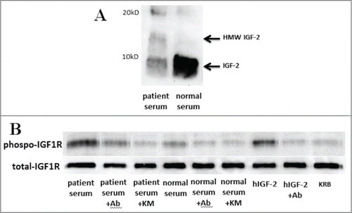 Figure 3. Western blot analysis and the kinase receptor activation assay of the patient's serum. (A) High molecular weight (HMW) and mature IGF-2 were detected in serum by western blot analysis using anti-IGF-2 antibody (ab9574). Each serum (40 μg of protein per lane) was separated by 15% SDS-PAGE. (B) IGF bioactivity in the patient's serum was greater than in a normal subject, and increased IGF bioactivity was inhibited to normal bioactivity level by the anti-IGF-2 specific antibody, ab9574, and increased IGF bioactivity was completely inhibited by the anti-IGF neutralizing antibody, KM1468. KRB; Krebs–Ringer bicarbonate buffer as a negative control, Ab; ab9574 (anti-IGF-2 specific antibody, final concentration 10 μg/ml), KM; KM1468 (anti-IGF neutralizing antibody, final concentration 10 μg/ml), hIGF-2; recombinant human IGF-2 (final concentration 10 ng/ml) as a positive control.