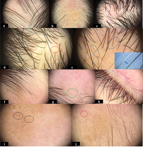 Figure 1 Representative dermoscopic signs of VAL (20×, 50×): (a) diameter diversity of leukotrichia,(b) clustered leukotrichia (yellow circle) with telangiectasia and scales, (c) red-white area (green and red arrows) with scales, (d) repigmented leukotrichia (Orange circles) and perifollicular depigmentation (red circle), (e) depigmented hair roots (blue circle) and Pohl-Pinkus constrictions of hair shaft under contrastive blue background (blue arrow). (f) Dermoscopic signs of eyebrow, (g) repigmented leukotrichia (green circle). (h) Dermoscopic signs of eyelashes: scattered white eyelashes with invisible perifollicular changes. Dermoscopic signs of vellus hair in (I and j): (i) Honeycomb-type hyperpigmentation (black circles) and residual perifollicular pigmentation (white circles), (j) perifollicular depigmentation (red circle) and telangiectasia.