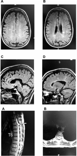 Figure 1 Pretreatment MRI.