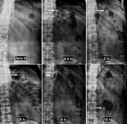 Figure 7 X-ray radiographic images indicating the position of optimized floating tablet (BaSO4-loaded) in the abdomen of a human volunteer at different time intervals (hours).