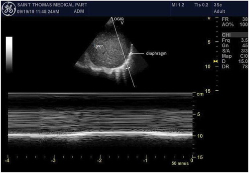 Figure 1. Point-of-care ultrasound of the right hemi-diaphragm in the posterolateral axillary line at the level of the costophrenic angle. A phased array probe was used, and M-mode is utilized to show lack of excursion of the diaphragm during deep breaths