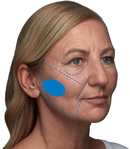 Figure 7 Pre-auricular hollowing: landmark deficiencies illustrating midface borders. The mid cheek ideally has a small concavity, resulting in a low light “shadow” from the zygoma above. In women, this concavity classically has an ovoid shape. In men, the shape tends to be more square or rectangular. Image courtesy from Merz Pharmaceutical GmbH.