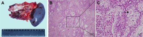 Figure 2 Gross photograph showing a firm and grayish white tumor from the spleen and the rest of the pancreas (A). Microscopically, it was predominantly composed of cells with abundant clear cytoplasm and well-defined cell borders (B, C).