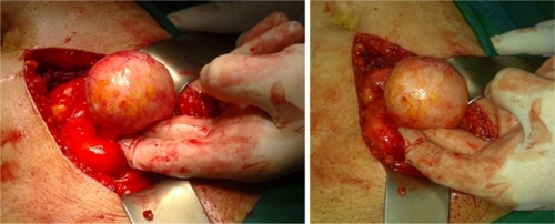 Figure 2 Intraoperative picture during surgical resection.