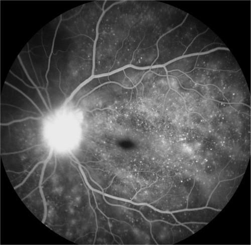 Figure 8 FFA photograph of a patient in the acute phase of VKHD showing optic disc leakage and numerous hyperfluorescent pinpoint foci of leakage at the level of RPE leading to the classic “starry sky” appearance.