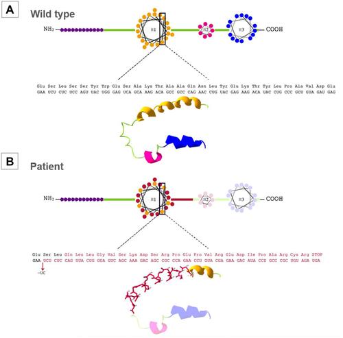 Figure 2 APOC2 protein scheme and three-dimensional visualization via Swiss-PDB Viewer. (A) Wild-type APOC2 protein. The purple polygons indicate the signal peptide domain. H1: helix 1; H2: helix 2; H3: helix 3. (B) Suggested structure of mutated APOC2 protein (p.Ser45Glnfs*24). The structure variation due to a frameshift mutation in protein is shown. In red: the aminoacid change; light color: the regions lost due to the premature stop codon.