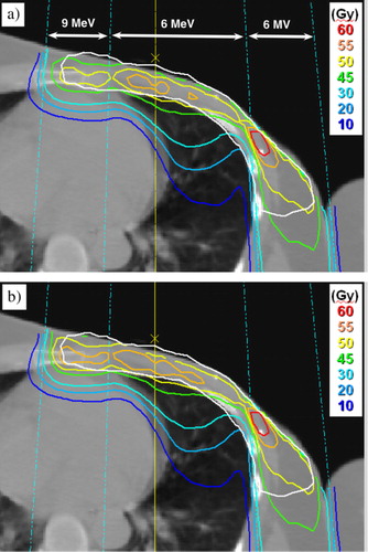 Figure 3.  Electron beam dose distributions for one of the patients with 6 and 9 MeV electrons and 6 MV photons, (a) insert plan and (b) eMLC plan. The PTV is marked with a white line.