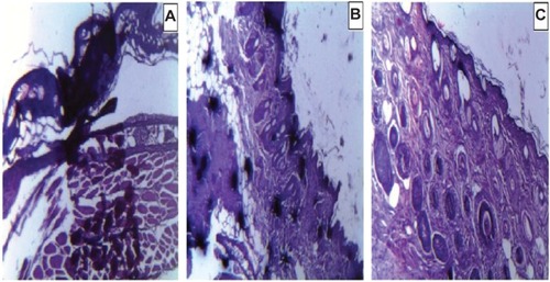 Figure 8 Histopathological analysis of MRSA-infected burn wound from Swiss albino mice.Notes: (A) Control, as of day 3. (B) Treated with free CAM, as of day 7. (C) Treated with CAM-PCL-P NPs, as of day 14. Slides were subjected to hematoxylin and eosin staining.Abbreviations: CAM, chloramphenicol; CAM-PCL-P NPs, chloramphenicol loaded with poly(ε-caprolactone)-pluronic composite nanoparticles; MRSA, methicillin-resistant Staphylococcus aureus.