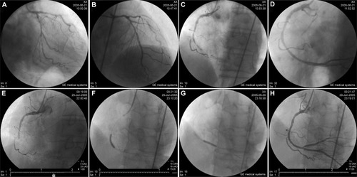 Figure 3 Coronary angiogram and PCI.