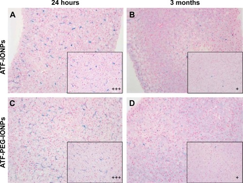 Figure 4 Detection of IONPs in the livers of rhesus monkeys by Prussian Blue staining.Notes: Original magnification: ×200; magnified to ×400 in black box. (A and C) are the biopsy samples of the liver obtained at 24 hours and massive IONPS seen in the kupffer cells (+ + +), and (B and D) are samples obtained at 3 months after the IONP injection, and sparse IONPs seen in the kupffer cells (+). The liver of Monkey 2 has weaker blue staining compared with that of Monkey 1 (A and C, respectively). And the levels of IONPs in the liver of monkeys are significantly decreased at 3 months posttreatment. No significant difference between (B and D) was observed.Abbreviation: IONPs, magnetic iron oxide nanoparticles.