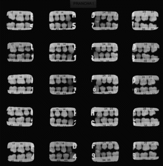 FIGURE 1 A typical plate of bitewing radiographs used to evaluation.