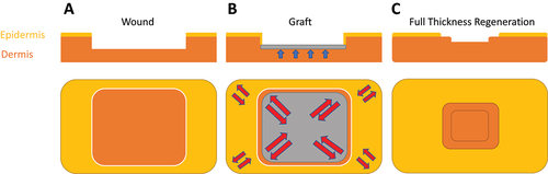 Figure 6. Comparison of the tissue reconstruction vs. tissue regeneration principles. In surgical tissue reconstruction of a partial-thickness dermal wound (A) a graft is placed and fixed in the defect for replacement of damaged dermal tissue (B). While grafts immediately provide adequate wound coverage, they also act as ‘spacers’ that obstruct tissue growth from the free wound edges, thus preventing the dermis from growing back to its original height (blue arrows), which leaves the grafted area thinner. This thinner part will be mechanically weaker and therefore more stretched than the surrounding intact tissue (red arrows) under normal loading, with the risk of overstretching. Following full graft take and integration, grafts undergo themselves contraction, which can further reduce tissue elasticity and range of motion. C) a regenerative therapy aims at supporting/stimulating new tissue growth which first restores the full height of the dermis and then epidermal healing from the free wound edges, additionally to uninhibited wound contraction.