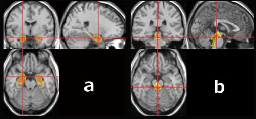 Figure 1 VOIs in the VSRAD® software program. (A) VOI in medial temporal lobe structures. (B) VOI in the dorsal brain stem.