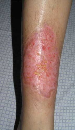 Figure 3 Characteristic cribriform scar after healing of pyoderma gangrenosum.