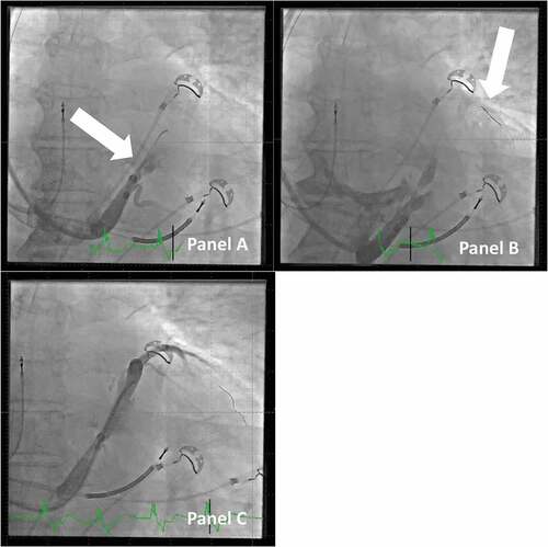 Figure 8. Dissection of the vein of marshall and how to proceed with lead implantation. Panel A: Injection of contrast dye in the CS, but with the j-shaped guidewire only in the vein of marshall (arrow). This creates a large dissection of the main CS. Panel B: The large dissection is clearly visible. A PCI guidewire (arrow) is passed by the part of CS with dissection onward to the anterior branch of CS. Panel C: A vein selector is tracked on the PCI guidewire across the part of CS with dissection, and contrast dye is injected to identify a probable target vein; the case can proceed despite the relatively large dissection.