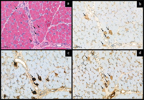 Figure 3 Necrotic fibers features on MxA and other IHCs. Sarcoplasmic MxA expression interpretation should be rigorous. (a) Five atrophic/shrinkage fibers with pale cytoplasmic stain were identified on H&E, 20X (black arrows). (b) The fibers revealed equivocal sarcoplasmic expression on MxA (black arrows). (c) The corresponding fibers revealed strong/clumping stained on MAC, 20X (black arrows). (d) Strong sarcoplasmic utrophin upregulation, 20X (black arrows). All stains represented that they were degenerated/necrotic fibers.