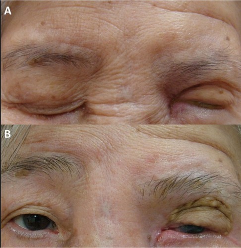 Figure 3 Surgical outcome.