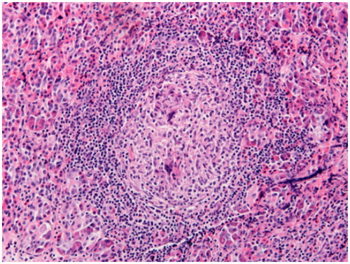 Figure 6. Sarcoidosis of pituitary gland, H&E: notice the multinucleated giant cells and presence of distinct lymphocytic cuff without significant fibrosis. Pituitary acini are present at the periphery (H&E stain, original magnification ×200).