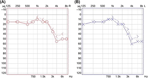 Figure 1. Pure-tone audiometry of a 45-year-old patient with a 7 year history of hypertension: (A) right ear; (B) left ear. Bilateral sensorineural, high-frequency and symmetric hearing loss is present. ○, ×, air conduction; >, <, bone conduction.