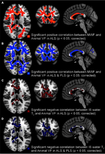 Figure 4. Regional white matter tract correlations, with a notable involvement of frontal lobe projections, between reduced category fluency and decreased MWF in ALS patients (A), decreased MWF in all patients (B), increased IE-water T2 in ALS patients only (C), and increased IE-water T2 in all patients (D). All p-values corrected for multiple comparisons. Images displayed by radiological convention.