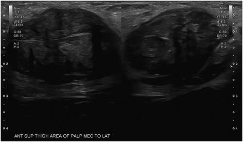 Figure 1. Ultrasound of the left upper thigh demonstrating a hypoechoic mass measuring 3.5 x 3 x 2.4 cm.