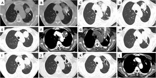 Figure 3. A typical case of secondary ablation treatment. The following images were of a 75-year-old patient with a 28-mm lesion of primary lung squamous cell carcinoma. The patient developed local progression 6 months after the first-line ablation without any other drug therapy and achieved a long-term PFS (24 months after the deadline for submission) after secondary ablation combined with chemotherapy and immunotherapy. (A) Chest computed tomography (CT) scan obtained before microwave ablation (MWA) shows a 28-mm well-defined round tumor (white arrow) in the left lobe (lesion adjacent to the aorta). (B) In the supine position, MWA was performed for the lung tumor. (C) CT after 24 h of the procedure; exudation and pleural effusion reduced. (D) CT performed 1 month after the procedure; the ablation area completely covered the tumor. (E) CT after 6 months of the procedure; ablation area increased. (F) CT 6 months after the procedure; Enhancement was seen in part of the tumor (triangular arrows). (G) In the supine position, MWA was performed for the enhanced part. (H) CT performed 1 month after the procedure; The ablation area completely covered the tumor. (I) CT after 3 months of the procedure; ablation area reduced. (J) CT after 6 months of procedure; cavity occurred in ablation areas. (K) CT after 24 months of the procedure; cavity shrunk. (L) CT after 24 months of the procedure; ablation area reduced.