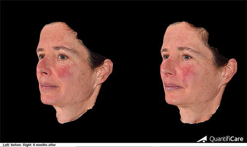 Figure 2 3D photographs of a 43-year-old female before (left) and six months after (right) nasolabial fold injection with HA filler. Photographs were taken with the LifeViz Mini 3D camera (Quantificare, USA).