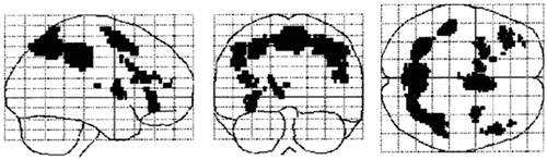 Figure 6. Callicott et al. [Citation137], in an n-back design with non-TBI, typical developed controls manipulated cognitive load and identified the working memory network as shown in the glass brain model. Reproduced with permission from Oxford University Press.