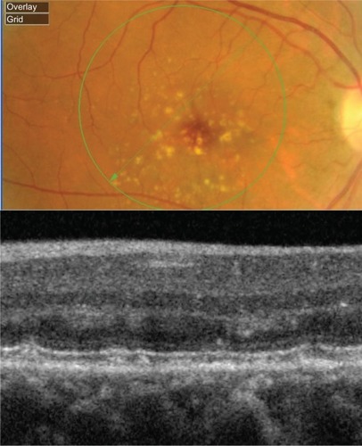 Figure 11 Fundus photograph (top) showing subretinal drusenoid deposits in the right eye of a patient with ARMD; the B-scan line on the fundus photograph has the same width as the B-scan SD-OCT image (bottom) which demonstrates the appearance of subretinal drusenoid deposits.