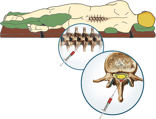 Figure 1 Demonstration of technique of epidural blood patch with placement of autologous blood into the epidural space.