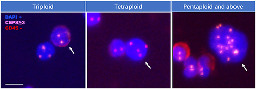 Figure 1 CTCs in patients with breast cancer. White arrows showed the identified CTCs. Scale bar is 10 μm.