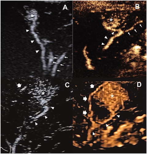 Figure 3. The examples illustrated the selection of target feeding arteries. (A) One subsegmental feeding artery (arrowhead) of the tumor (asterisk) was clearly depicted in the early arterial phase of 2D-CEUS, which is typically suitable for FAA. The principle of both sparing the non-feeding branches (fine arrow) and non-contact to the tumor could be achieved. (B) The tumor (asterisk) was not selected for FAA because of insufficient distance to the bifurcation of feeding (arrowhead) and non-feeding branches (arrow). (C) two subsegmental feeding arteries (arrowhead and thick arrow) of the tumor (asterisk) were selected as the targets of FAA, which were partly visible on 2D-CEUS through back-and-forth breathing movement. (D) Real-time 3D-CEUS depicted the two feeding arteries (arrowhead and thick arrow) in the reconstructed image with good continuity and contributed to feasibility determination. FAA: feeding artery ablation; CEUS: contrast-enhanced ultrasound.
