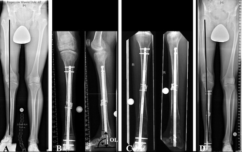 Figure 4. Patient No. 9 with additional osteotomy for angular correction. A—Preoperative radiographs showing LLD of 75 mm and mid-shaft tibial valgus malalignment. B—A second osteotomy was performed on the apex of the deformity for angular correction in addition to a distal corticotomy for callus distraction. The osteotomy level (OL) is measured as the distance from the tibial osteotomy site (drawn as a line parallel to the nail) to a perpendicular line aligned tangentially with the most plantar aspect of the calcaneus on the lateral radiograph (70.4 mm, meta-diaphyseal). The mid-shaft osteotomy was bridged by the ILN and additionally fixed using a locking plate to prevent proximal distraction. C—Full consolidation of the mid-shaft osteotomy and beginning callus consolidation after distraction of 65 mm. D—Postoperative radiograph showing a residual LLD of 11 mm and correction of the tibial valgus malalignment.