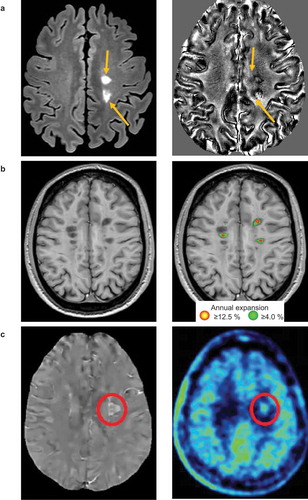 Figure 1. Example of chronic active lesion visualization using different neuroimaging modalities. (A) On 3D axial fluid-attenuated inversion recovery sequence, two hyperintense white matter lesions are visible. Both lesions (orange arrows) show a hypointense rim on phase image derived from a multi echo gradient-echo T2* sequence, thus they represent ‘iron rim lesions.’ (B) White matter lesions showing a linear expansion on serial MRI scans (i.e. ‘slowly expanding lesions’ [SELs]) can be identified by linearly fitting the Jacobian of the non-linear deformation field between timepoints obtained using merged T1- and T2-weighted images scans. In particular, T2-hyperintense lesions containing one cluster showing a linear annual increase ≥12.5% and embedding neighboring voxels with an annual increase of at least 4% are classified as SELs. (C) Demonstration of a chronic active lesion showing a peripheral rim on quantitative susceptibility mapping (QSM) (red circle) and 11C-PK11195 uptake, a marker of activated microglia/macrophages, on positron emission tomography (red circle). Figure 1(c) adapted from [Citation11] by permission of Oxford University Press on behalf of the Guarantors of Brain