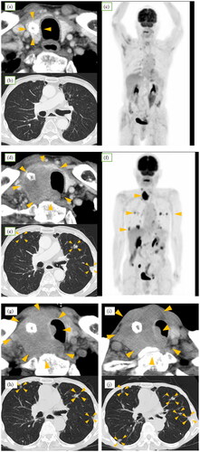 Figure 1. Time course of computed tomography (CT). (a–c) Eight months prior to discovery of the mass, only coarse calcified lesions were detected in the right lobe of the thyroid (arrowheads), with no evidence of metastasis to the lungs or throughout the body. (d) and (e) Neck and chest CT before treatment indicating ∼4-cm hypoechoic mass in the right lobe of the thyroid gland, suggesting infiltration into the trachea and cervical esophagus and multiple nodules in lungs (arrowheads). (f) Positron emission tomography-CT before treatment demonstrating approximate accumulation in the right lobe of the thyroid and lung nodules, with no uptake detected in other organs. Although partial accumulation was noted in the small intestine, it was considered a false positive, as no lesions were identified on CT images. (g) and (h) Enlargement of tumor and infiltration into the trachea after treatment with doxorubicin. Slight shrinkage of pulmonary nodules (arrowheads) was observed. (i) and(j) Further progression of tumor and pulmonary nodules after treatment with pazopanib (arrowheads).