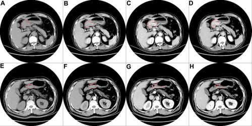 Figure 1 NC-CT and CE-CT scans of GACs with different DP-cCAV. CT images in the noncontrast phase (A), arterial phase (B), portal venous phase (C) and delayed phase (D) showed a thickened gastric wall in a patient of DP-cCAVhigh group. CT images in the noncontrast phase (E), arterial phase (F), portal venous phase (G) and delayed phase (H) showed a thickened gastric wall in a patient of the DP-cCAVlow group.