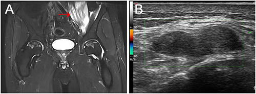 Figure 1 Magnetic resonance imaging results. (A) Magnetic resonance imaging revealed the abscess in left psoas, gluteus maximus and iliac muscles (red arrow indicated), intermuscular encapsulated effusion, as well as enlarged lymph nodes in the left inguinal region. (B) Color Doppler ultrasound revealed a honeycomb, hypoechoic area in left Hip.