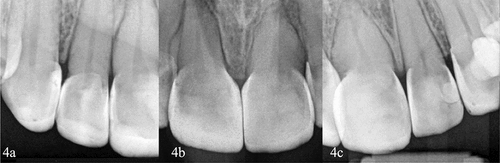 Figure 4. Clinical case II. Two weeks radiographic control composition to check the subgingival marginal composite integrity and the absence of gaps and retentive areas, the radiopacity of the composite allows us to notice the pores absence and the continuity of the restoration without undercuts. (a) Adaptation of composite in the papilla area from right mesial upper canine to distal upper right central incisor. (b) Excellent adaptation of the composite between the central incisors drawing the new natural and progressive emergence profiles. (c) Adaptation of composite in the papilla area from left distal upper central incisor to mesial upper left canine.