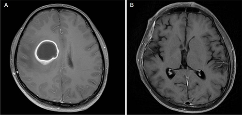Figure 5 Enhanced cranial magnetic resonance imaging in patients with intracranial infections on T1-weighted images. (A) On October 23, 2022, rounded nodular abnormal-density foci about 2.9×3.6 cm in size could be seen in the right frontoparietal lobe. (B) After 7 weeks of treatment, no significant foci of enhancement could be observed.