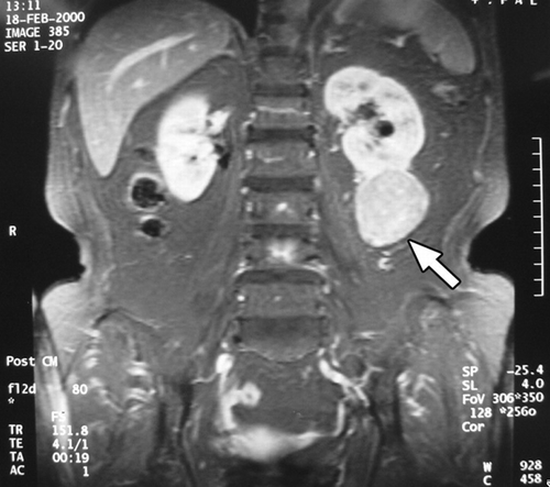 Figure 4. Magnetic resonance imaging of case 3. A 5-cm protruding mass (arrow) in the inferolateral aspect of the left kidney.