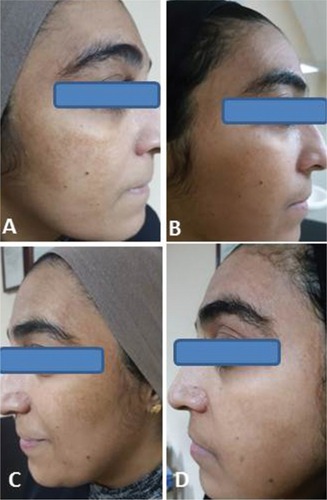 Figure 2 A 43-year-old female patient with a 7-year history of melasma: (A) before treatment with fractional Er:YAG laser + HQ cream, (B) clinical appearance 12 weeks after starting therapy, (C) before treatment with HQ cream alone, and (D) clinical appearance 12 weeks after starting therapy.