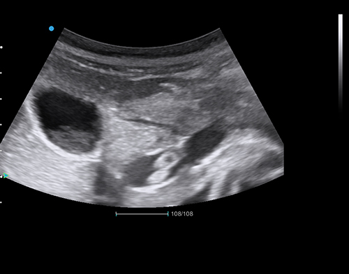 Figure 1 Ultrasound image showing two adjacent Ascaris worms in the common bile duct.