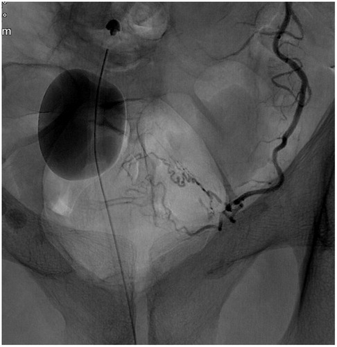 Figure 1. Angiography of left inferior vesical artery, in Prostate Artery Embolization (PAE) treatment.