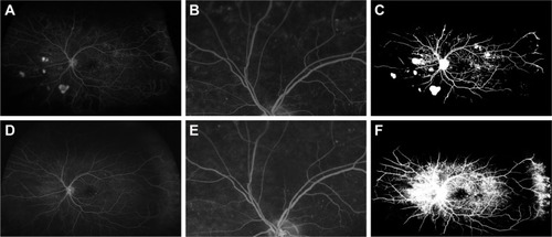 Figure 1 Reperfusion in eye of a 61-year-old male, following treatment with 5 injections of ranibizumab.