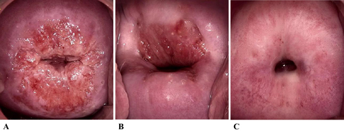 Figure 1 Type of transformation zone (TZ). (A) Type 1. (B) Type 2. (C) Type 3.