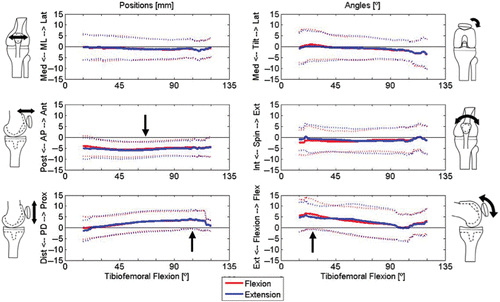 Figure 9. The changes between pre-arthroplasty and post-arthroplasty kinematics (mean and standard deviation), for all six degrees of freedom, flexion and extension phases, are shown with respect to the femoral bone reference. Arrows indicate significant differences.The patella was more posterior, more proximal and more flexed after arthroplasty (p < 0.008) due to “rounding the femoral corner” sooner; see the text and Figure 12 for an explanation of these paradoxical results given more distal patellar contact on the femoral component. None of the primary tracking characteristics (ML shift, ML tilt, int/ext spin) showed a significant bias in one direction or the other, although individual changes were potentially relevant (see Figure 10) [Color version available online.].