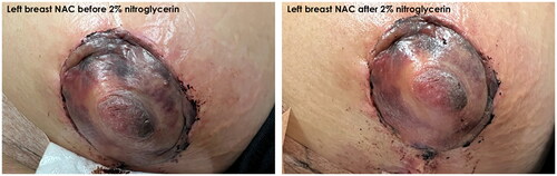 Figure 3. Comparison of NAC before (left) and after (right) application of 2% nitroglycerin ointment and intravenous methylprednisolone.