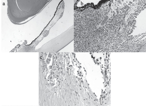 Figure 2 Enucleated left eye (hematoxylin and eosin). (a) Melanoma diffusely spread throughout the iris and invading the ciliary body (×10). (b) Iris root and corneal endothelial invasion by epithelioid melanoma cells (×60). (c) Tumor cells (arrows) seeding the trabecular meshwork (×80).